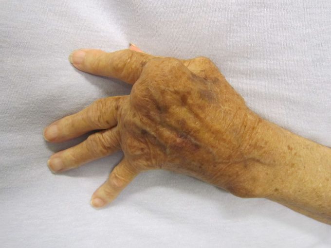 Name the deformity and the disease in which it occurs?