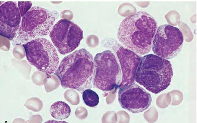 #Imagebasedinfo:-
➖➖➖➖➖➖
Acute  promyelocytic  leukemia  with  the  t(15;17)  (FAB  M3  subtype). 
➖➖➖➖➖➖➖
🔴 Bone  marrow  aspirate  shows  neoplastic promyelocytes  with  abnormally  coarse  and  numerous  azurophilic  granules. 

🟣 Other  characteristic  findings  include  the  presence  of  several  cells  with " bilobed  nuclei" and  a  cell  in  the  center  of  the  field  that  contains  multiple  needle-like  "Auer  rods" .