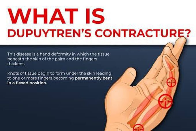 Dupuytren's contracture