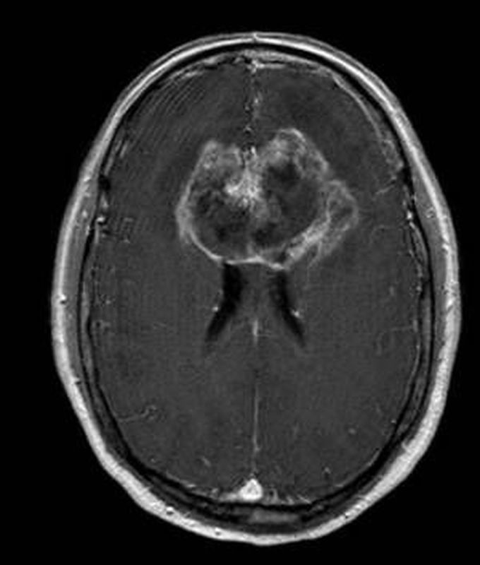 Butterfly Glioblastoma