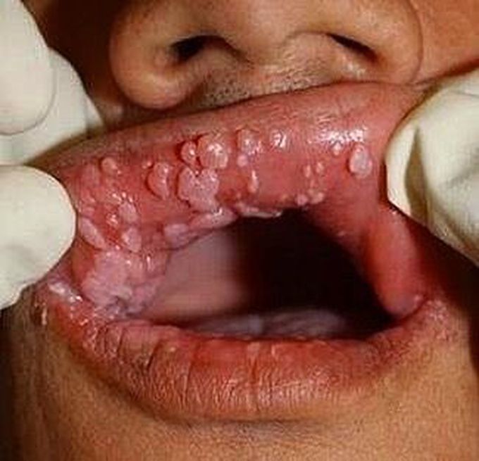 Oral cavity warts all over!!