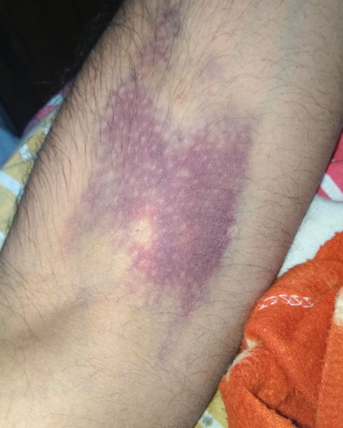 A 22 yr old patient complaining of dark reddish brown patch around the site of needle prick after a blood donation of 450 ml with slight tender around it...... appears 11 hr after donation of blood.........