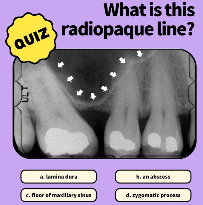 Identify the Radiopaque Line