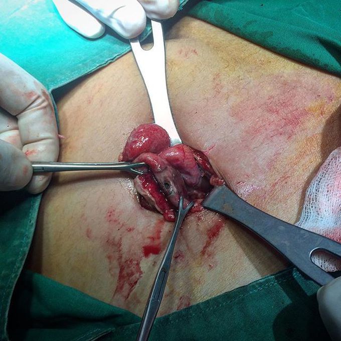 Perforated Appendix