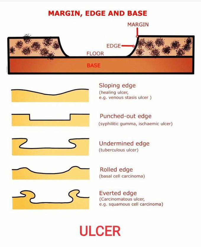 Types of ulcerations