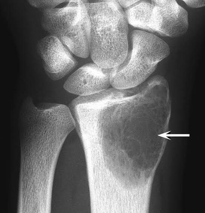 Giant cell tumor