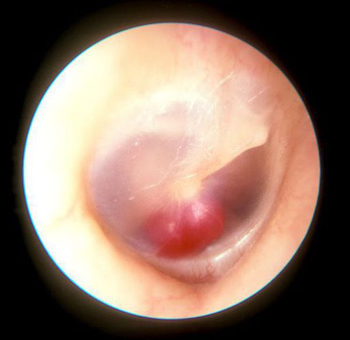 Glomus Tumor "rising sun appearance"