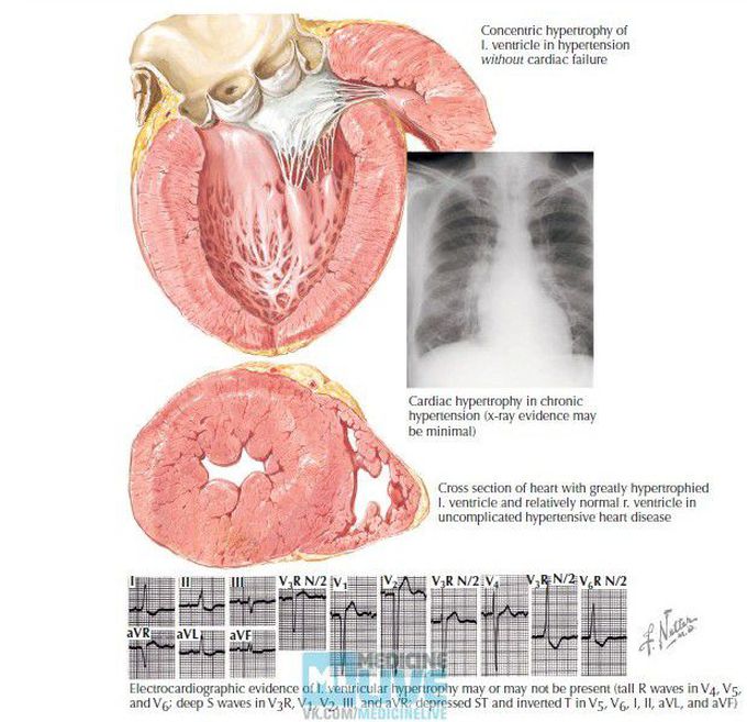 Ventricular hypertrophy