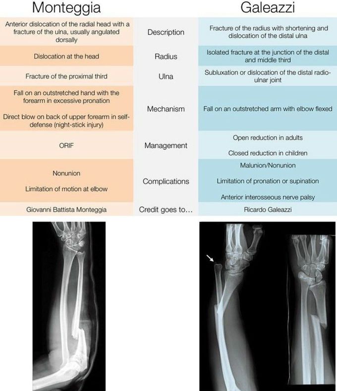 Fracture ortho