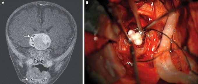Brain Tumor (toothy)