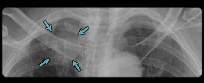 RIGHT APICAL LUNG MASS