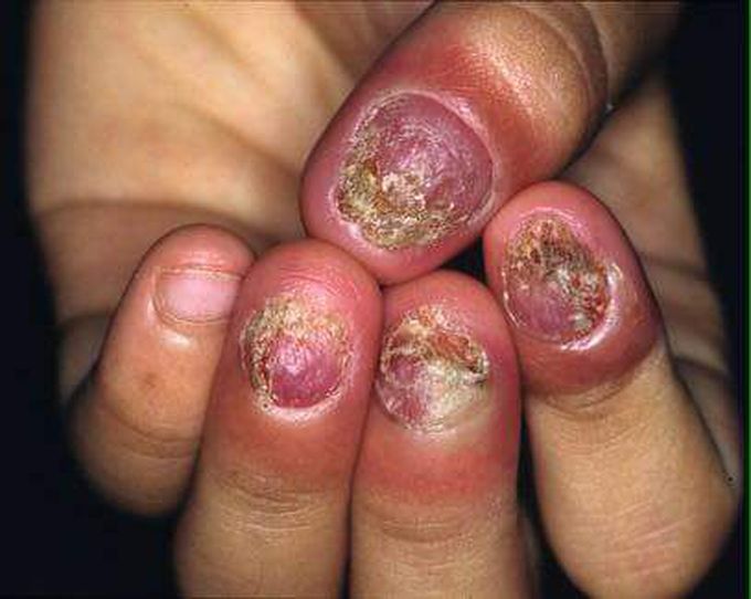 What is your spot diagnosis?

 A. Tinea corporis 
B. Tinea cruris
C. Tinea unguium
D. Tinea versicolor