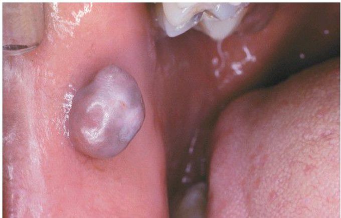 Fibroma