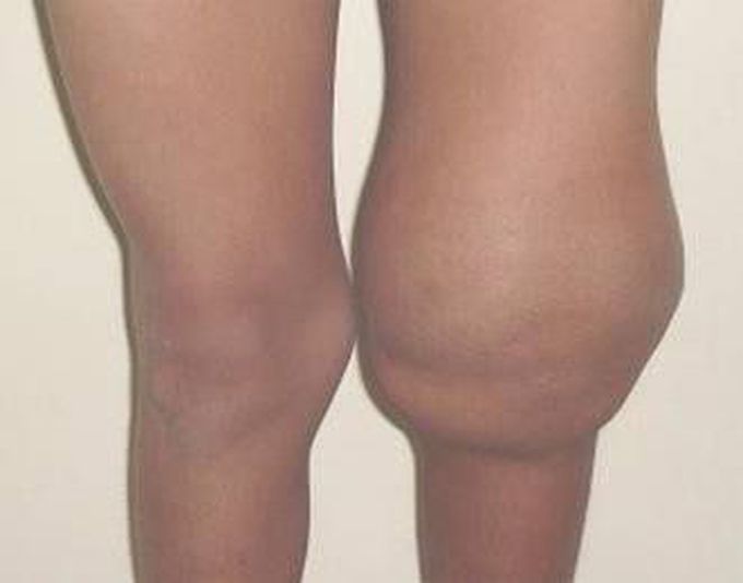 Hemarthrosis