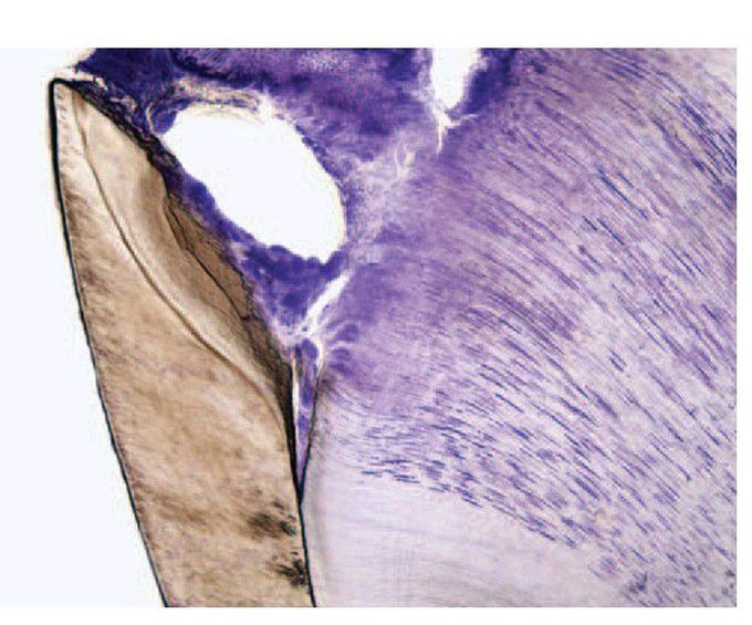 Progression of dental caries