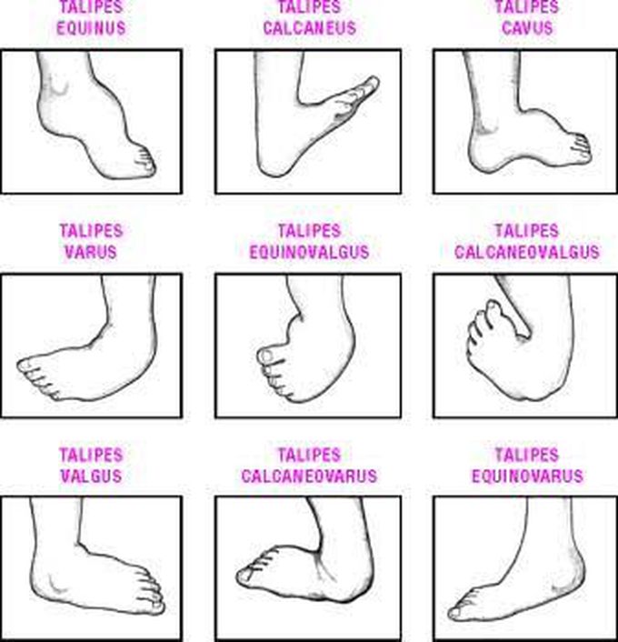 Types of club foot