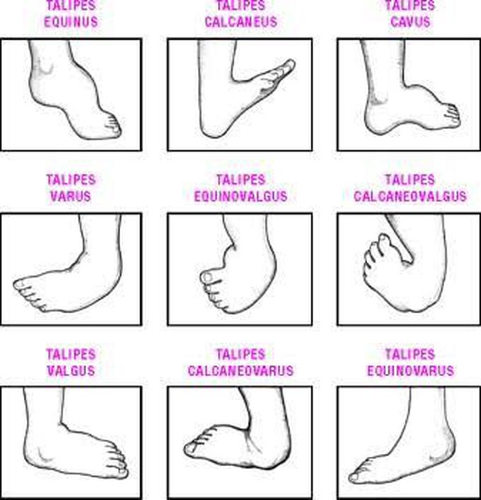 Types Of Club Foot Medizzy