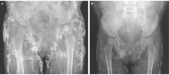 Calcinosis in Juvenile Dermatomyositis