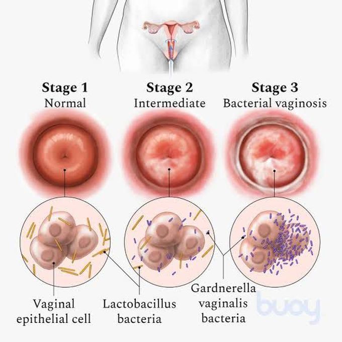 How do you get bacterial vaginosis?