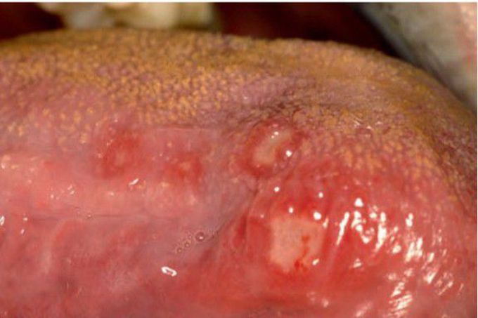 Minor aphthous ulcers