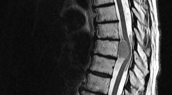 Red Flags in Spinal Pathology