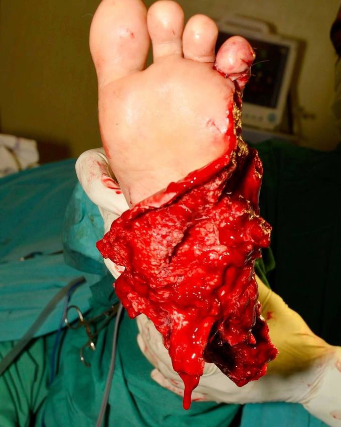 Foot injury