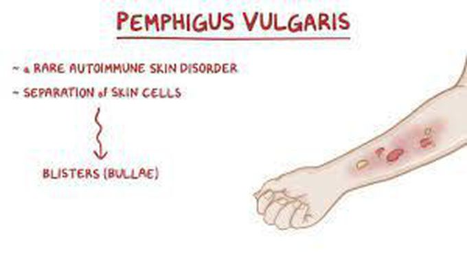 Causes of Pemphigus