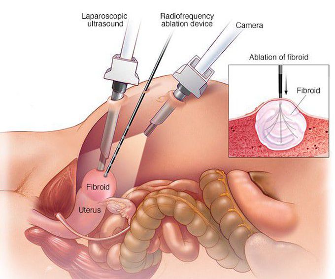 Treatment of Uterine fibroids