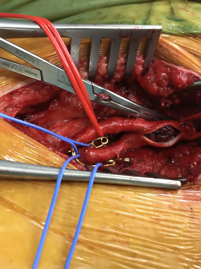 Acute limb ischemia