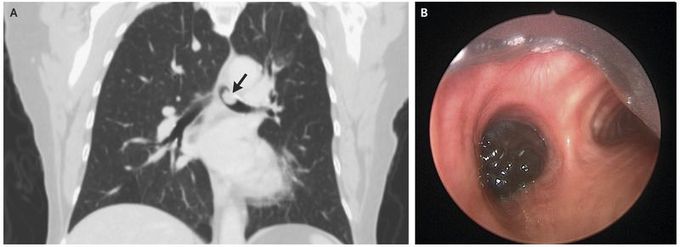 Melanoma in the Bronchus
