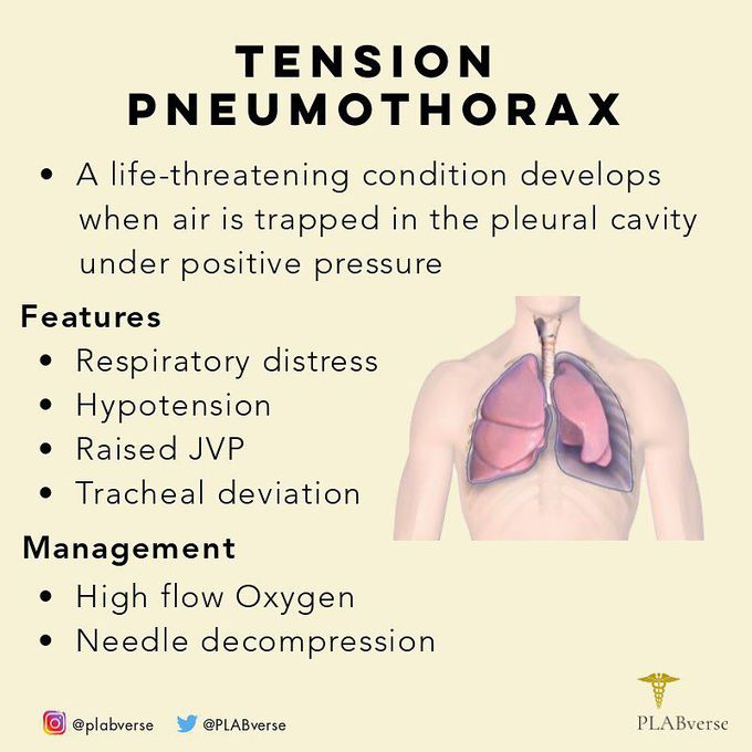 Pneumothorax tension Optimal Needle