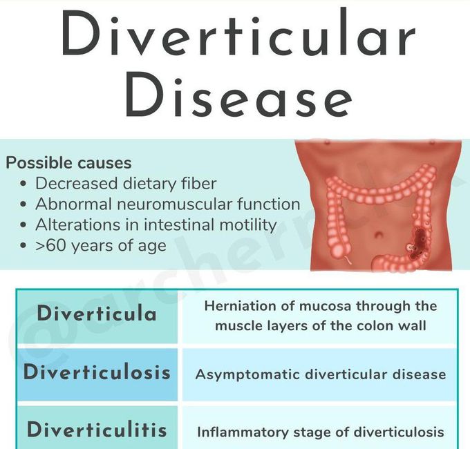 Diverticular Diseases