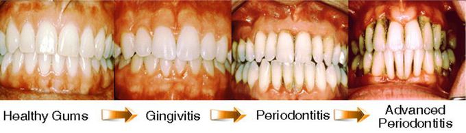 Periodontitis