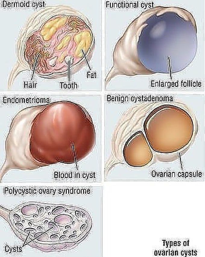 Types of ovarian cyst