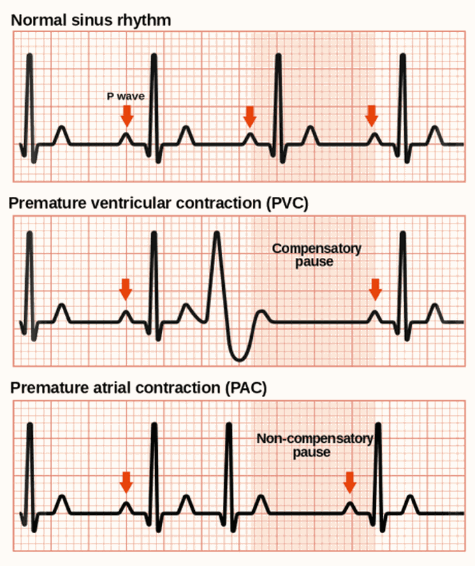 Premature atrial and Ventricular Contraction