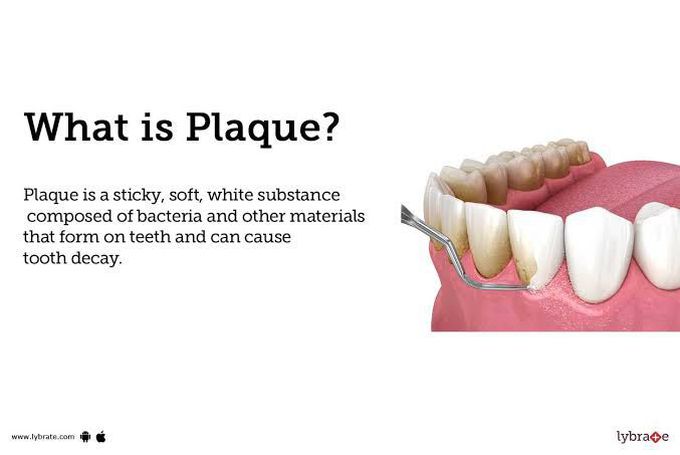 What is plaque?