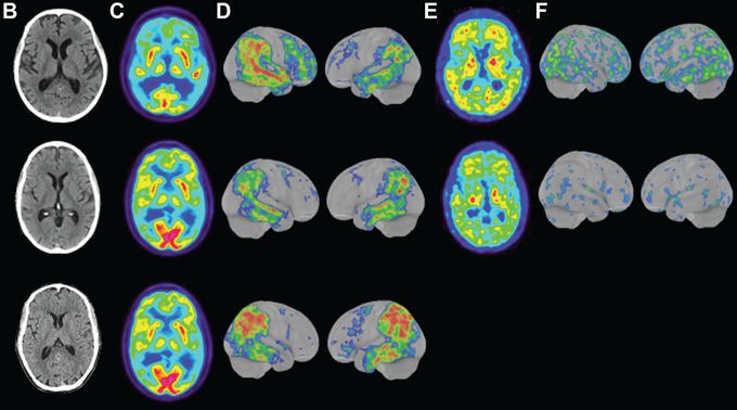 Rare, Aggressive Form of Early-Onset Alzheimer's Discovered