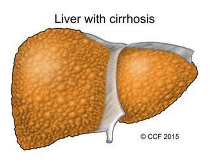 Symptoms of cirrhosis - MEDizzy