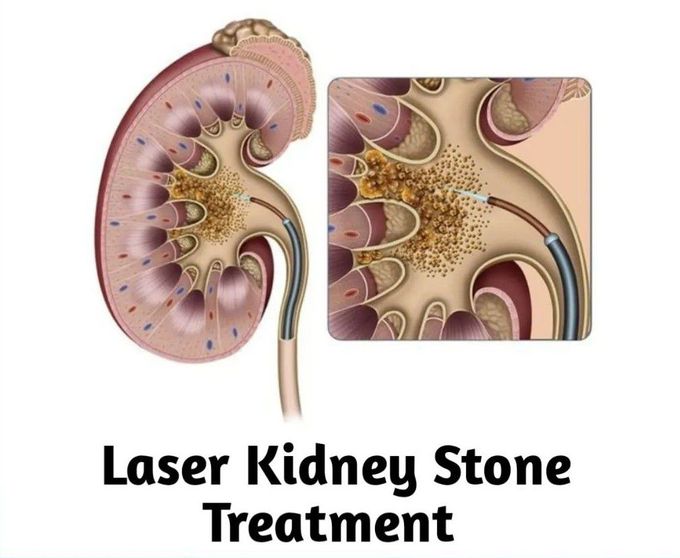 Lithotripsy