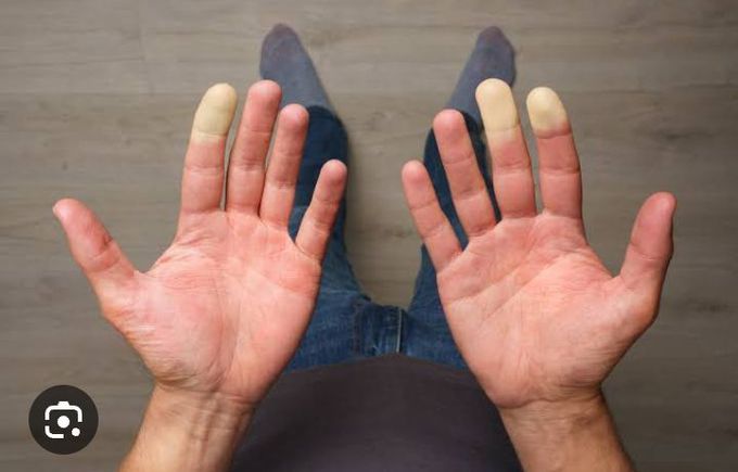 Raynaud's syndrome symptoms