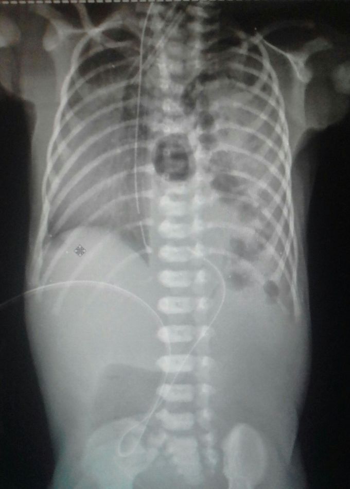 X-Rays to newborn