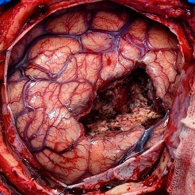 Brain Tumour