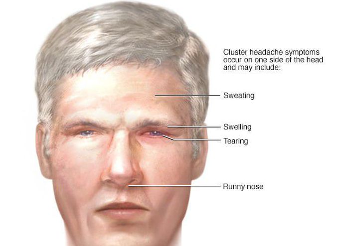 Cluster headache.