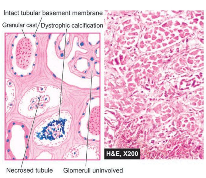 Toxic Acute tubular necrosis