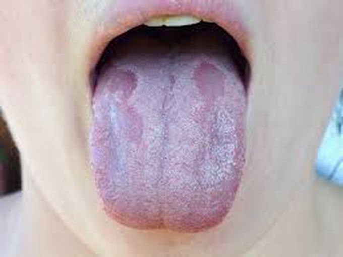 Treatment of oral thrush