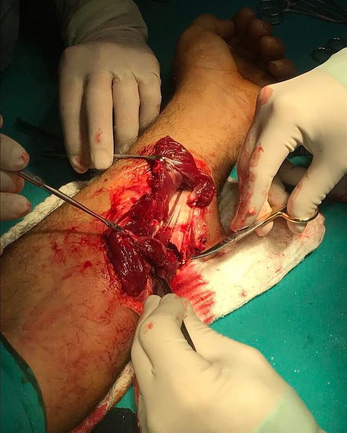 Extensive forearm injury due to a workplace accident