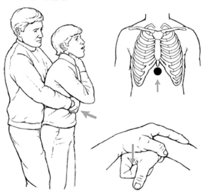 Heimlich maneuver