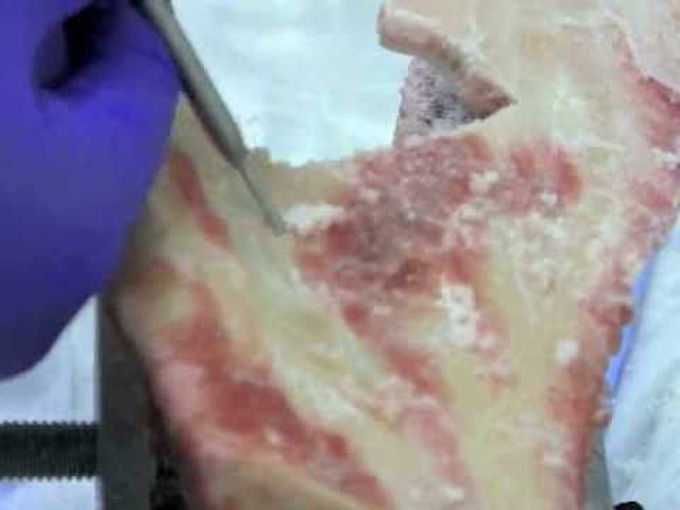 Performing a Craniotomy Flap