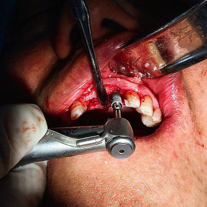 Dental implant placement in a fresh extraction socket