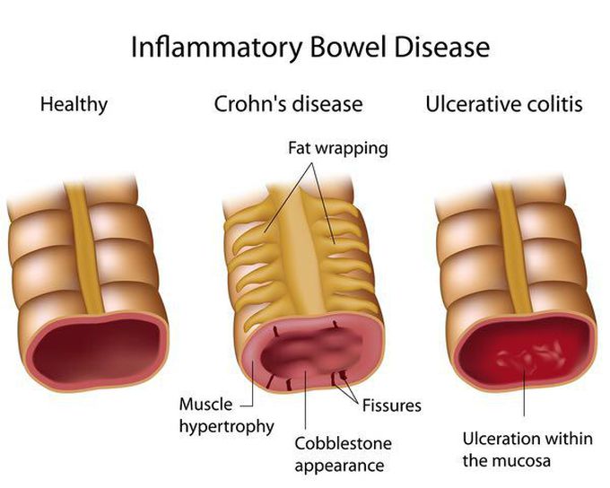 Inflammatory bowel disease